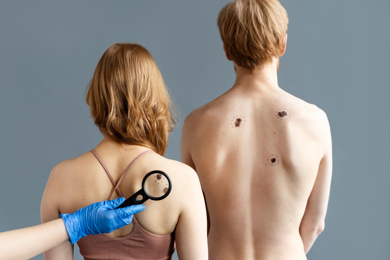 Skin Cancer Screening on the Gold Coast